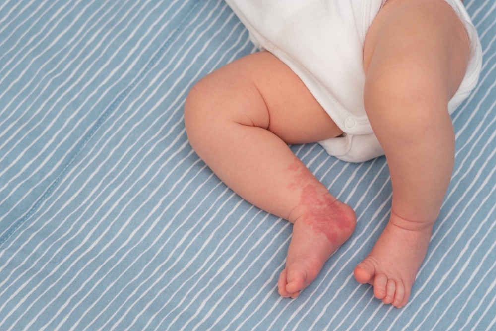 Angioma sulla caviglia di un neonato sdraiato su lenzuola a righe celesti e bianche